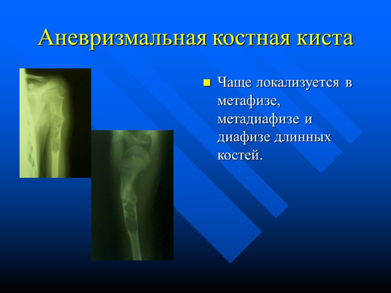 Аневризмальная костная киста Чаще локализуется в метафизе, метадиафизе и диафизе длинных костей.